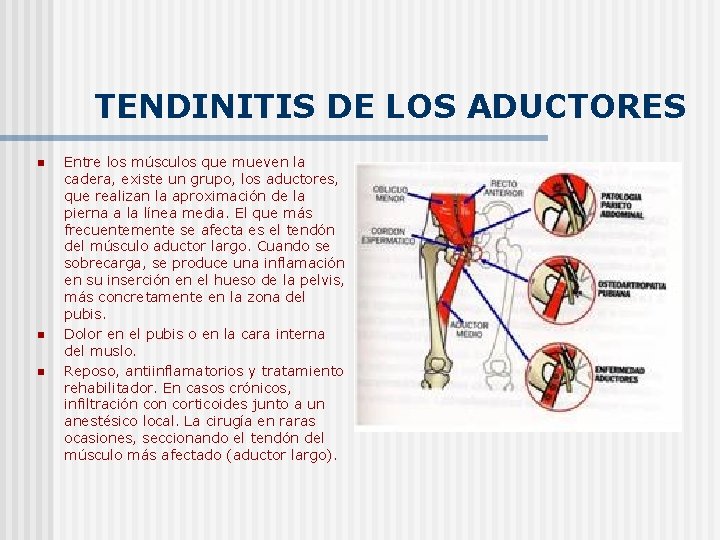 TENDINITIS DE LOS ADUCTORES n n n Entre los músculos que mueven la cadera,