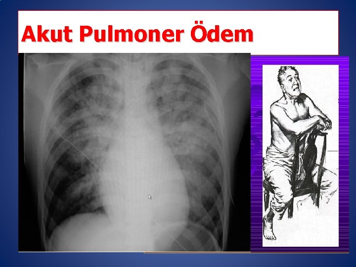 Akut Pulmoner Ödem 