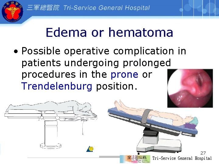 Edema or hematoma • Possible operative complication in patients undergoing prolonged procedures in the