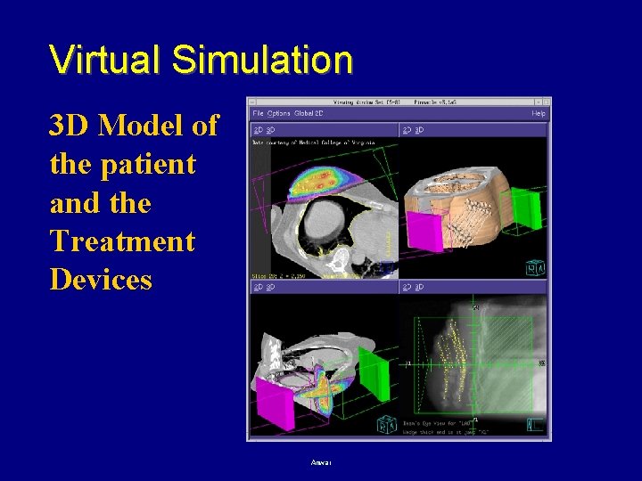 Virtual Simulation 3 D Model of the patient and the Treatment Devices Anwar 25