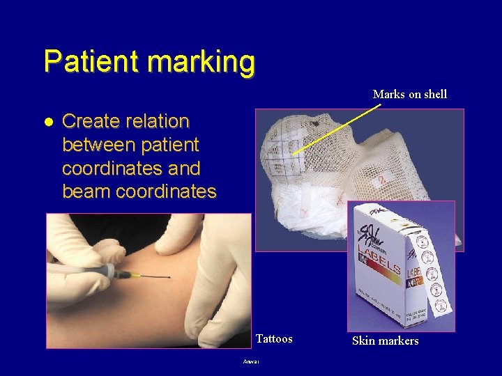 Patient marking Marks on shell l Create relation between patient coordinates and beam coordinates