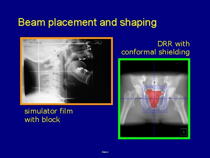 Beam placement and shaping DRR with conformal shielding simulator film with block Anwar 42