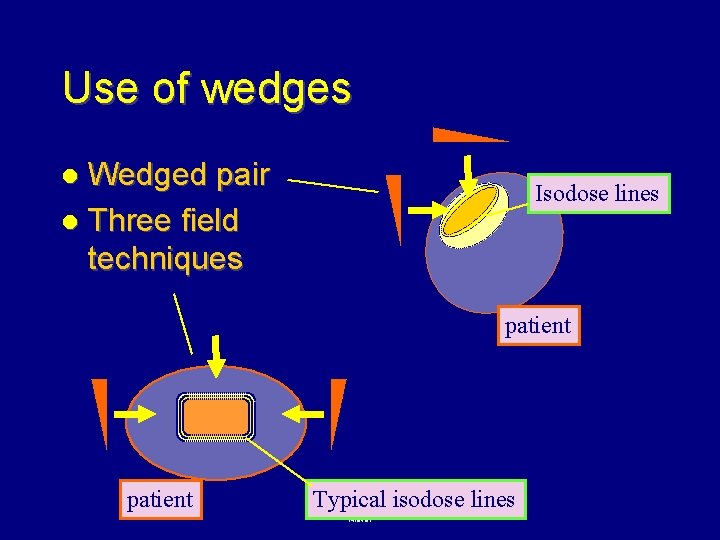 Use of wedges Wedged pair l Three field techniques l Isodose lines patient Typical