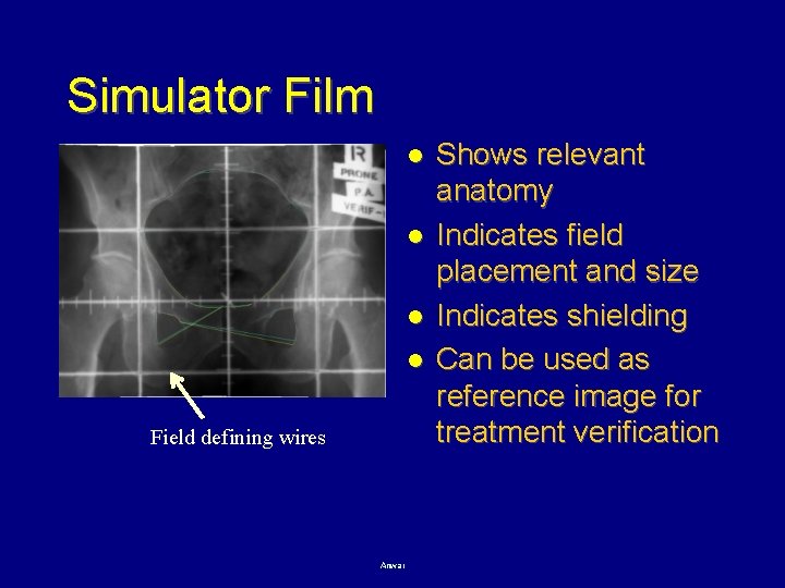 Simulator Film l l Field defining wires Anwar Shows relevant anatomy Indicates field placement