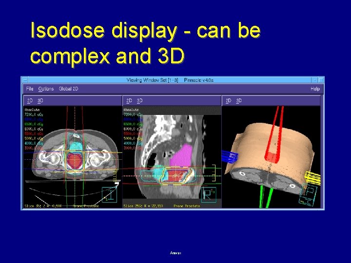 Isodose display - can be complex and 3 D Anwar 73 