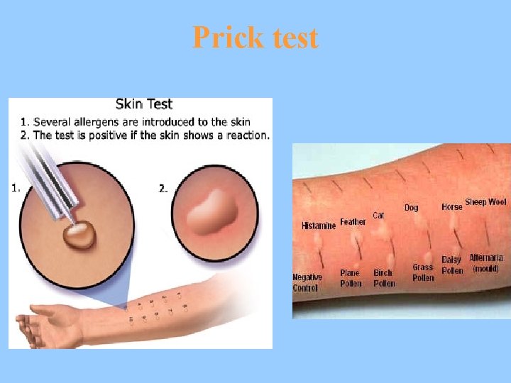 Prick test 