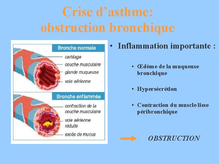 Crise d’asthme: obstruction bronchique • Inflammation importante : • Œdème de la muqueuse bronchique