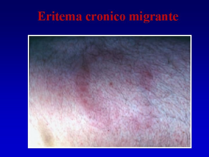 Eritema cronico migrante Eritema cronico migrante