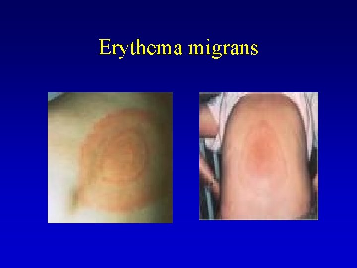 Erythema migrans 