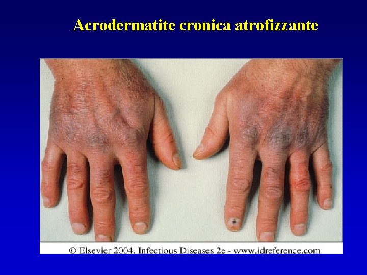 Acrodermatite cronica atrofizzante 