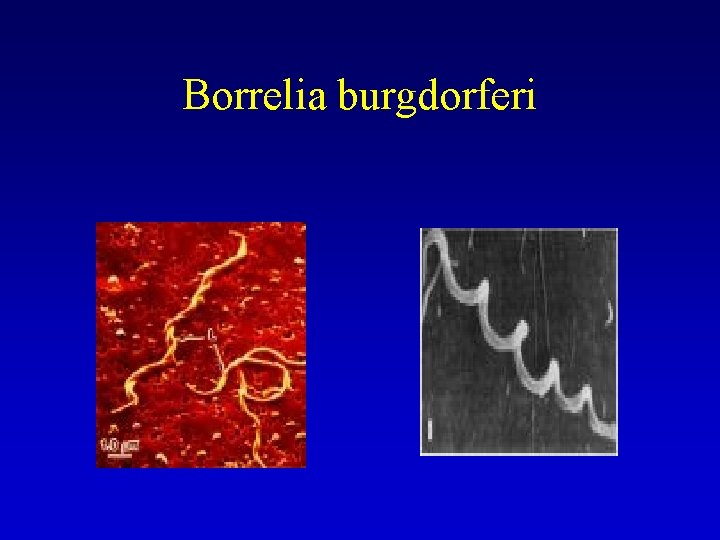 Borrelia burgdorferi 