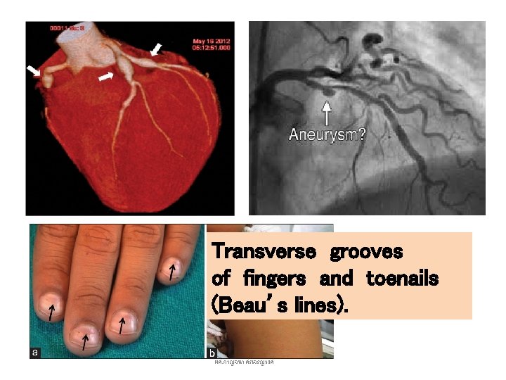 Transverse grooves of fingers and toenails (Beau’s lines). ผศ. กาญจนา ศรเจรญวงศ 