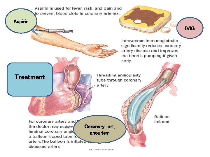 Aspirin IVIG Treatment Coronary art. aneurism ผศ. กาญจนา ศรเจรญวงศ 