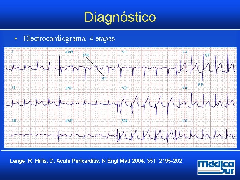 Diagnóstico • Electrocardiograma: 4 etapas Lange, R, Hillis, D. Acute Pericarditis. N Engl Med Diagnóstico • Electrocardiograma: 4 etapas Lange, R, Hillis, D. Acute Pericarditis. N Engl Med