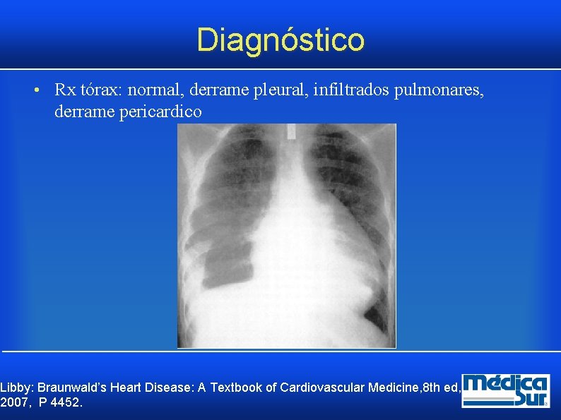 Diagnóstico • Rx tórax: normal, derrame pleural, infiltrados pulmonares, derrame pericardico Libby: Braunwald’s Heart Diagnóstico • Rx tórax: normal, derrame pleural, infiltrados pulmonares, derrame pericardico Libby: Braunwald’s Heart