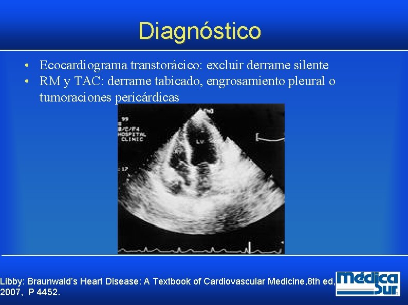 Diagnóstico • Ecocardiograma transtorácico: excluir derrame silente • RM y TAC: derrame tabicado, engrosamiento Diagnóstico • Ecocardiograma transtorácico: excluir derrame silente • RM y TAC: derrame tabicado, engrosamiento