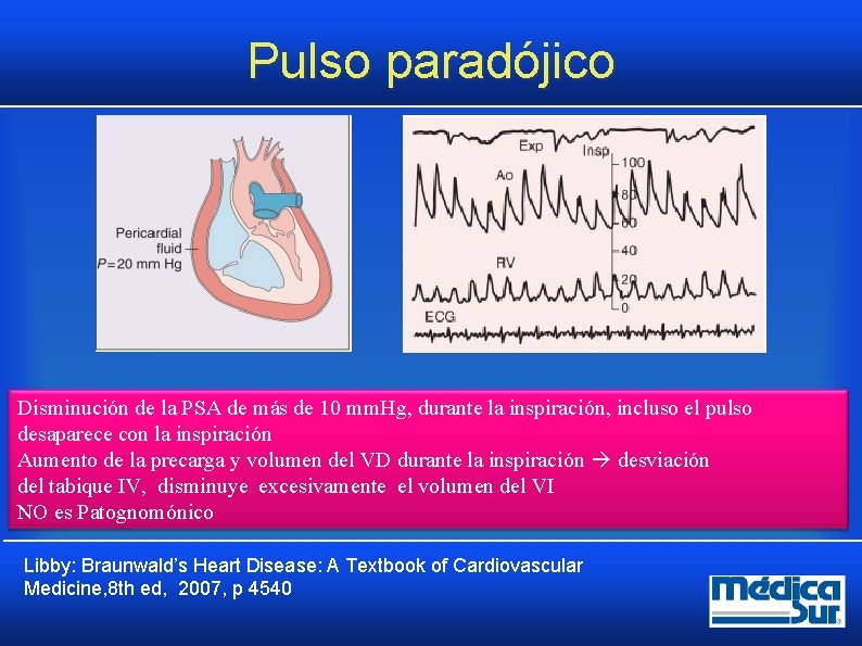 Pulso paradójico Disminución de la PSA de más de 10 mm. Hg, durante la Pulso paradójico Disminución de la PSA de más de 10 mm. Hg, durante la