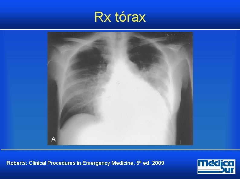 Rx tórax Roberts: Clinical Procedures in Emergency Medicine, 5ª ed, 2009 Rx tórax Roberts: Clinical Procedures in Emergency Medicine, 5ª ed, 2009