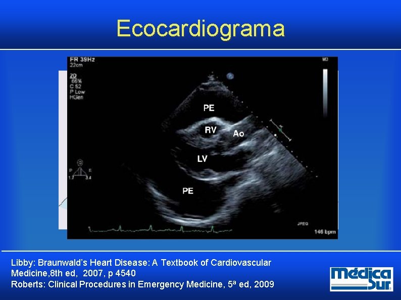 Ecocardiograma Libby: Braunwald’s Heart Disease: A Textbook of Cardiovascular Medicine, 8 th ed, 2007, Ecocardiograma Libby: Braunwald’s Heart Disease: A Textbook of Cardiovascular Medicine, 8 th ed, 2007,