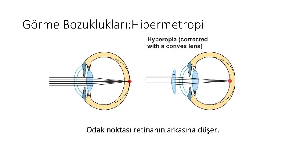 Görme Bozuklukları: Hipermetropi Odak noktası retinanın arkasına düşer. 