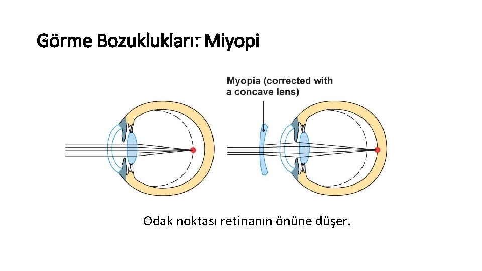 Görme Bozuklukları: Miyopi Odak noktası retinanın önüne düşer. 