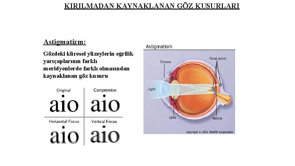 KIRILMADAN KAYNAKLANAN GÖZ KUSURLARI Astigmatizm: Gözdeki küresel yüzeylerin eğrilik yarıçaplarının farklı meridyenlerde farklı olmasından