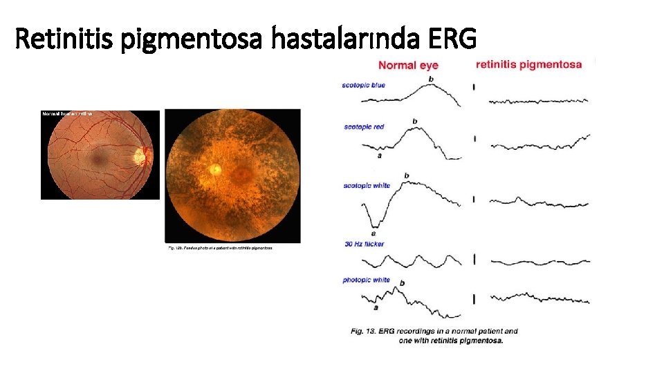 Retinitis pigmentosa hastalarında ERG 