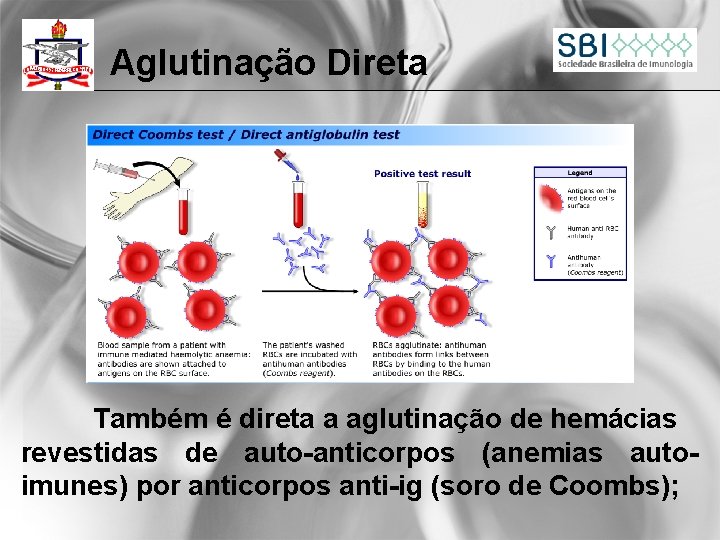 Aglutinação Direta Também é direta a aglutinação de hemácias revestidas de auto-anticorpos (anemias autoimunes)