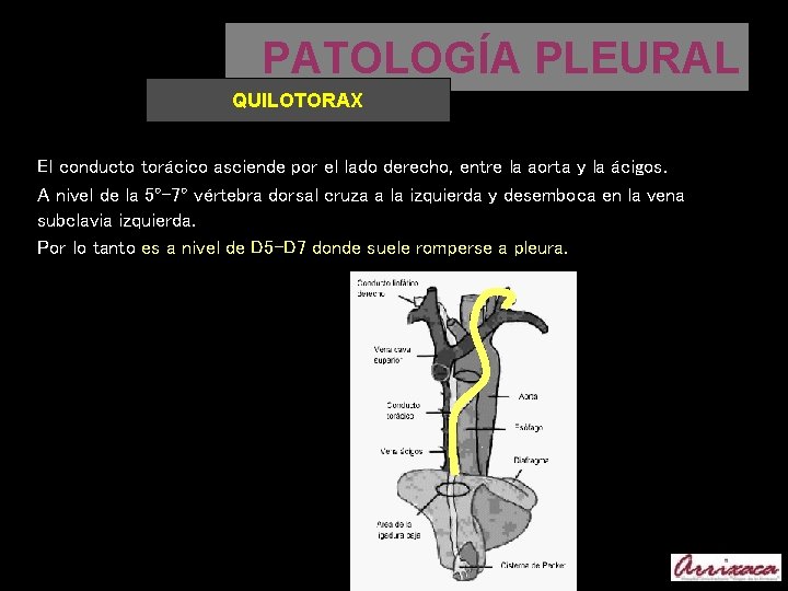 PATOLOGÍA PLEURAL QUILOTORAX El conducto torácico asciende por el lado derecho, entre la aorta