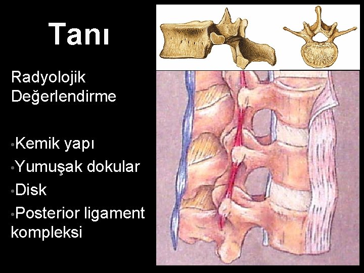 Tanı Radyolojik Değerlendirme • Kemik yapı • Yumuşak dokular • Disk • Posterior ligament