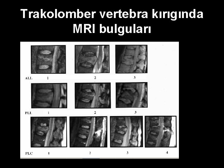 Trakolomber vertebra kırıgında MRI bulguları 