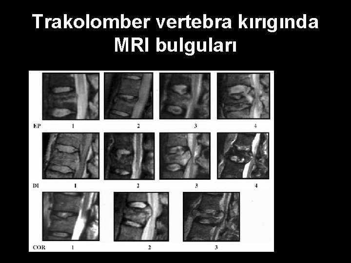 Trakolomber vertebra kırıgında MRI bulguları 