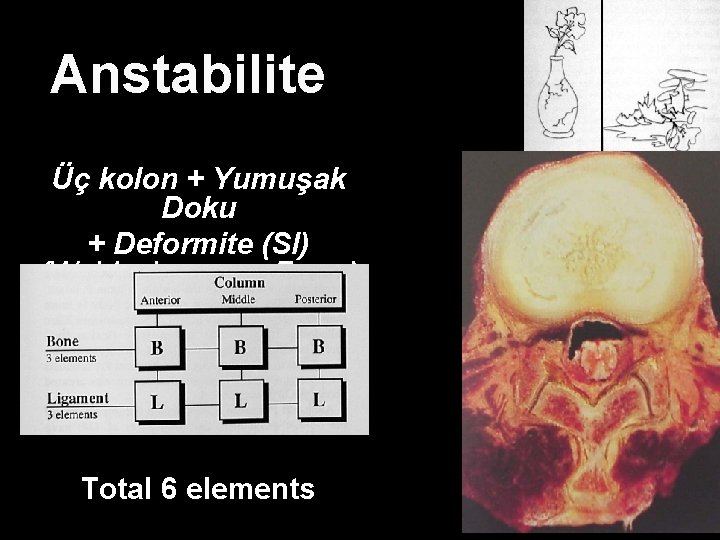 Anstabilite Üç kolon + Yumuşak Doku + Deformite (SI) (Weidenbaum ve Farcy) Total 6