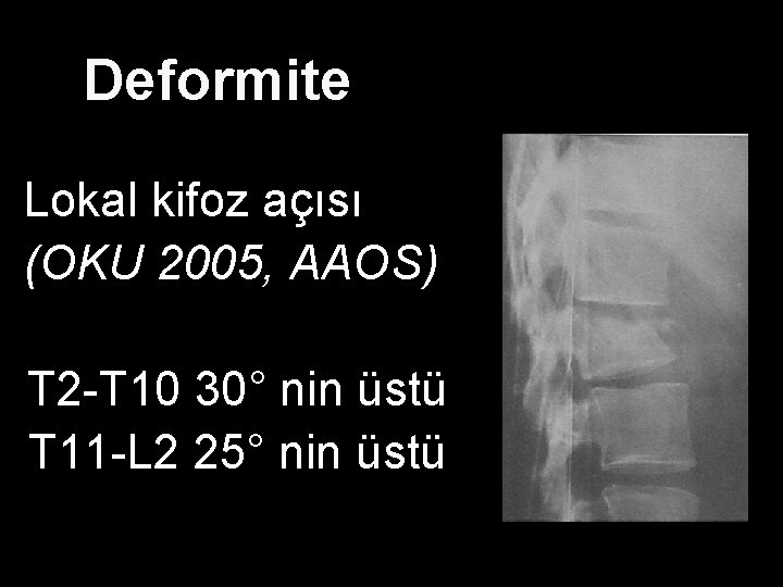 Deformite Lokal kifoz açısı (OKU 2005, AAOS) T 2 -T 10 30° nin üstü