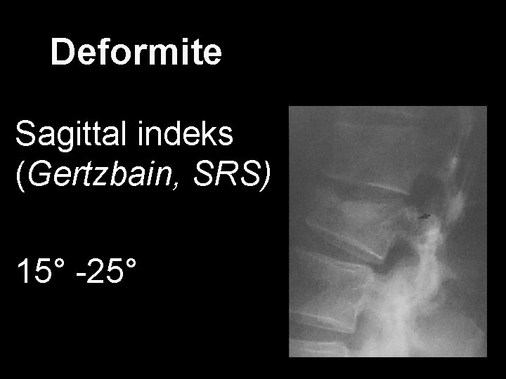 Deformite Sagittal indeks (Gertzbain, SRS) 15° -25° 