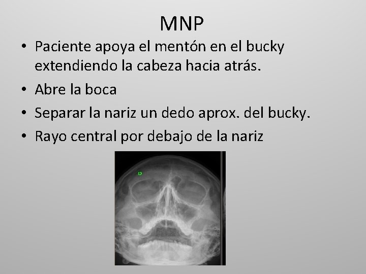 MNP • Paciente apoya el mentón en el bucky extendiendo la cabeza hacia atrás.