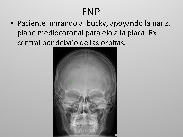 FNP • Paciente mirando al bucky, apoyando la nariz, plano mediocoronal paralelo a la