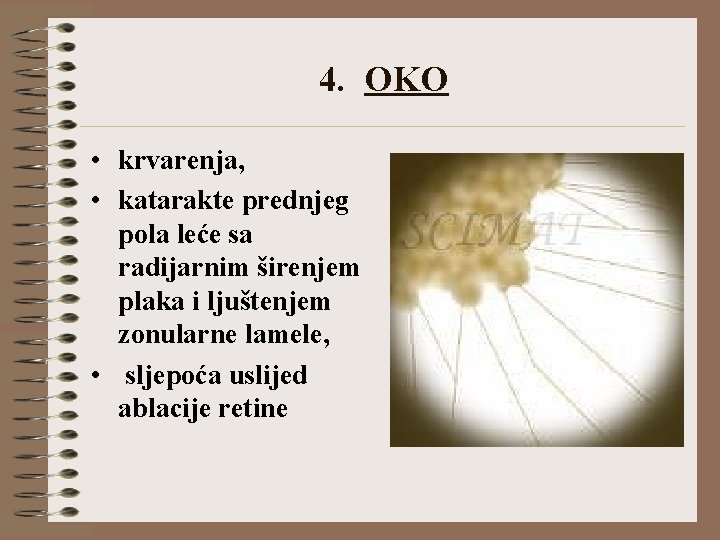 4. OKO • krvarenja, • katarakte prednjeg pola leće sa radijarnim širenjem plaka i