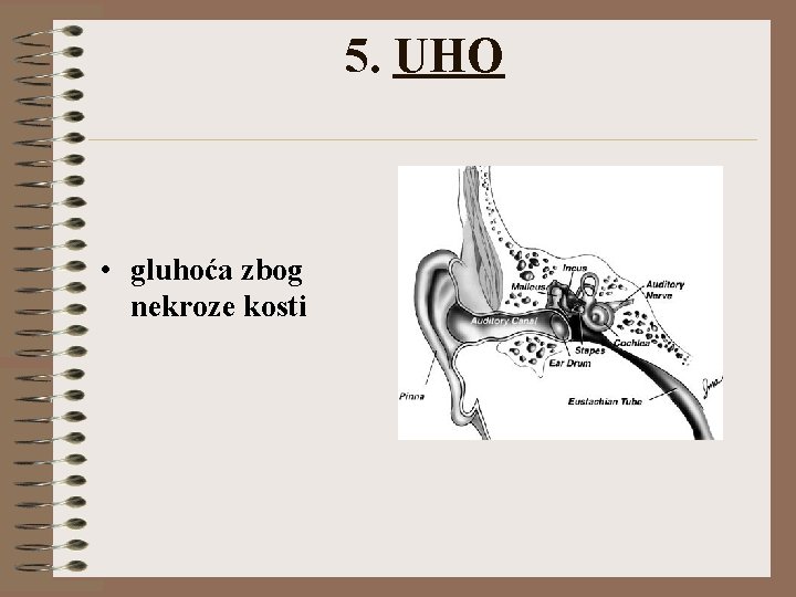 5. UHO • • gluhoća zbog nekroze kosti 