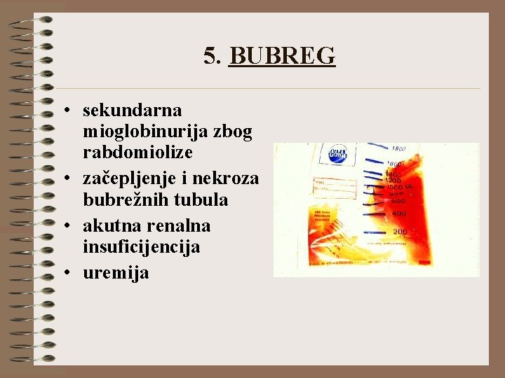 5. BUBREG • sekundarna mioglobinurija zbog rabdomiolize • začepljenje i nekroza bubrežnih tubula •