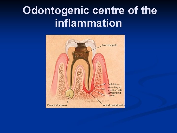 Odontogenic centre of the inflammation 