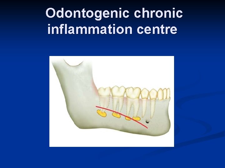 Odontogenic chronic inflammation centre 