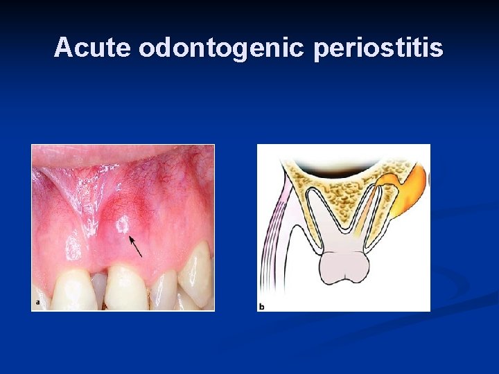 Acute odontogenic periostitis 