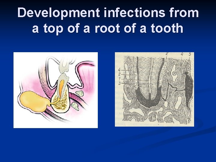Development infections from a top of a root of a tooth 