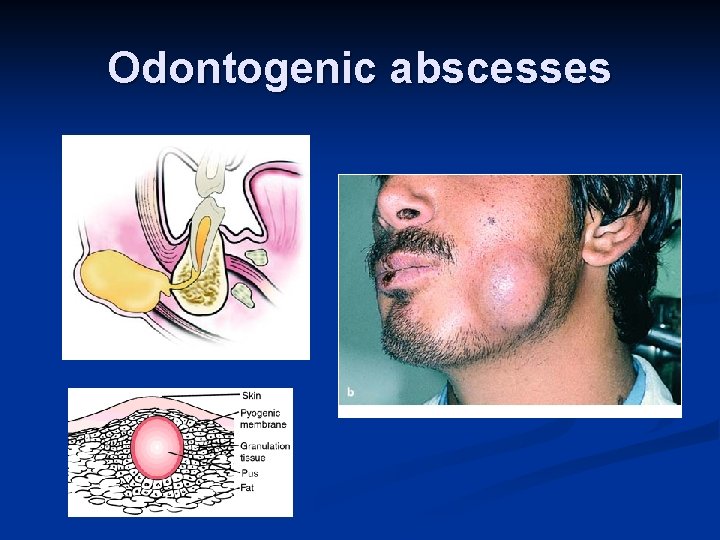 Odontogenic abscesses 