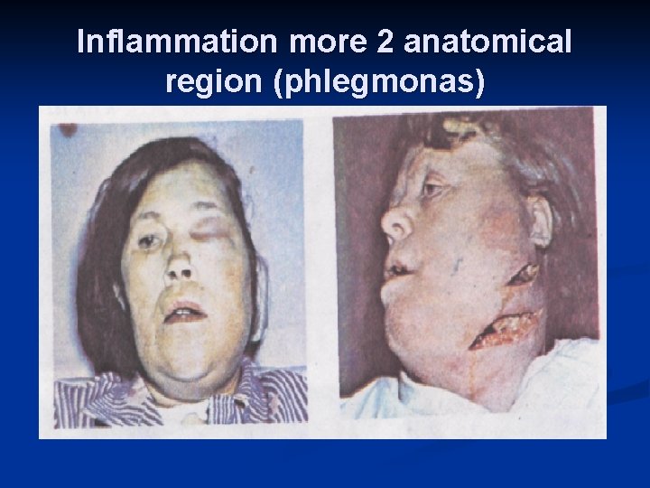 Inflammation more 2 anatomical region (phlegmonas) 