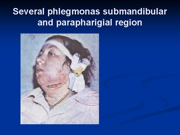 Several phlegmonas submandibular and parapharigial region 