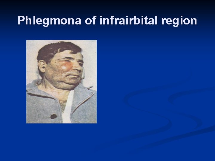 Phlegmona of infrairbital region 