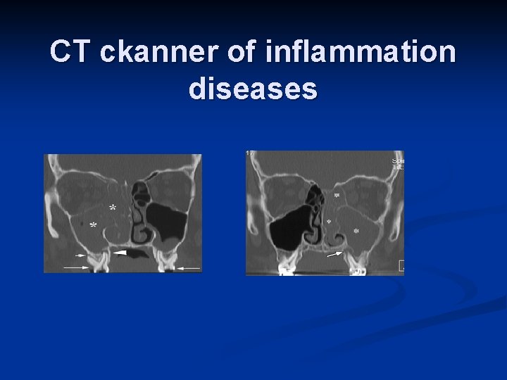 CT ckanner of inflammation diseases 