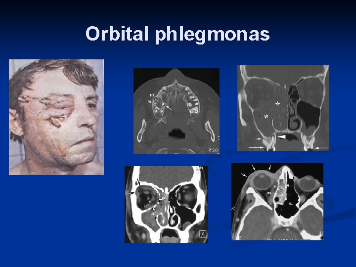 Orbital phlegmonas 
